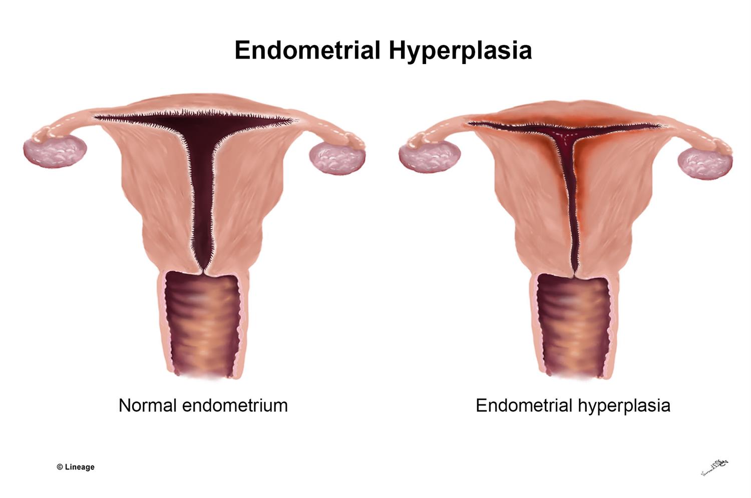 endometrium adalah