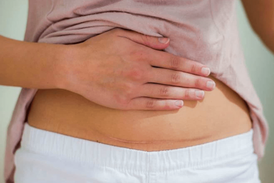 penyebab endometriosis