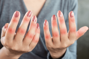 Mengenal Perbedaan Autoimun dan Lupus Secara Mendalam