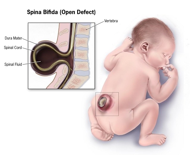 spina bifida adalah