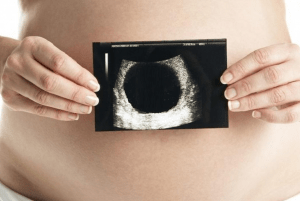 Apa Itu Blighted Ovum? Pahami Secara Mendalam Di Sini