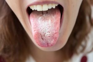 Mengenal Candidiasis Beserta Gejala dan Penyebabnya