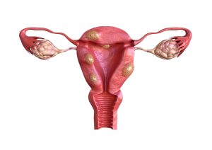 Mengenal Penyakit Fibroid Rahim dan Cara Mengatasinya