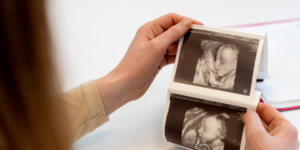 Prolaps Tali Pusat: Kondisi, Risiko, dan Penanganannya