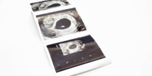 Perkembangan Janin 6 Minggu dan Perubahan pada Ibu