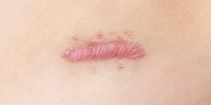 Apakah Keloid Menyulitkan Proses Persalinan