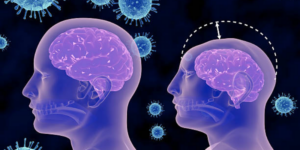 Mikrosefali: Penyebab, Gejala dan Pencegahan