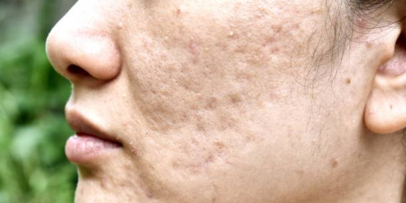 Dampak Kelebihan Hormon Androgen pada Wanita 1 Dampak Kelebihan Hormon Androgen pada Wanita