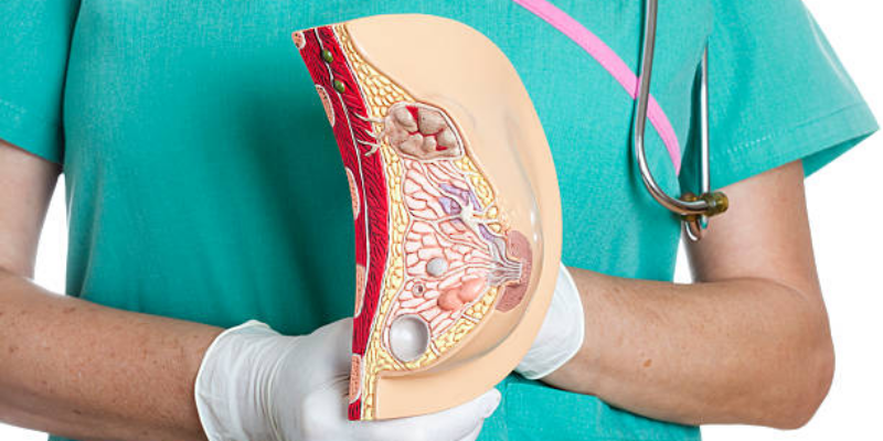 Galaktokel pada Ibu Menyusui, Perlukah Khawatir? 2 Galaktokel pada Ibu Menyusui