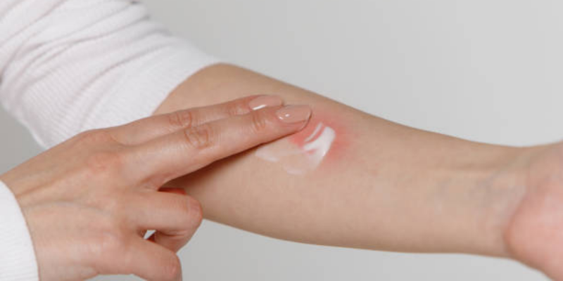 Amankah Lotion Anti Nyamuk untuk Ibu Hamil?