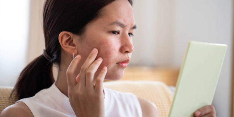 Penyebab Jerawat Saat Hamil dan Cara Mengatasinya 1 Jerawat Saat Hamil