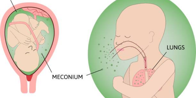 Sindrom Aspirasi Mekonium: Penyebab, Gejala, dan Penanganannya