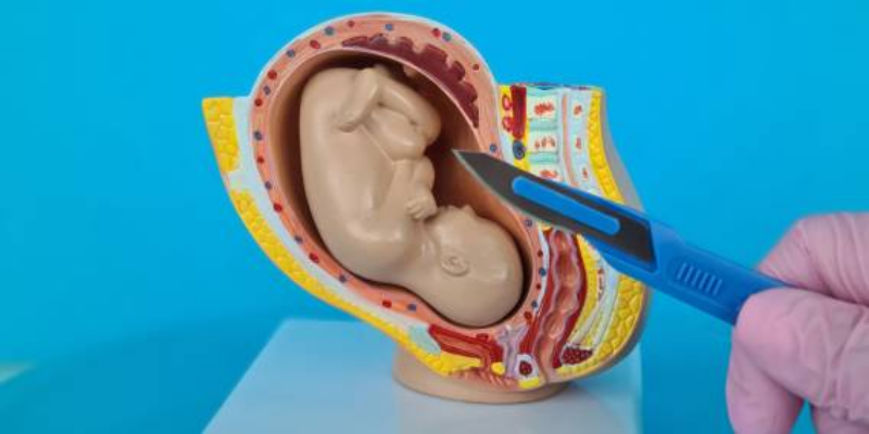 Sindrom Aspirasi Mekonium