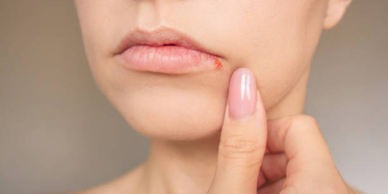 Kenali Herpes pada Ibu Hamil, Cara Mencegahnya?