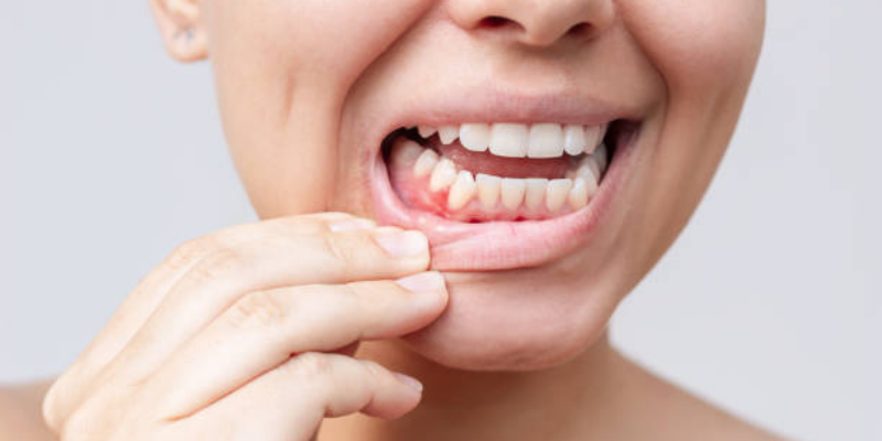 Penyebab Gusi Berdarah Saat Hamil dan Solusi Amannya